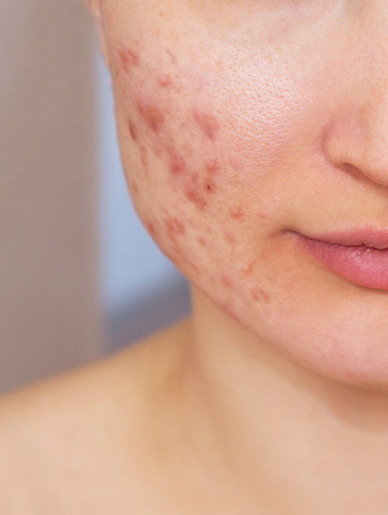 cropped shot of a young woman's face before and after acne treat