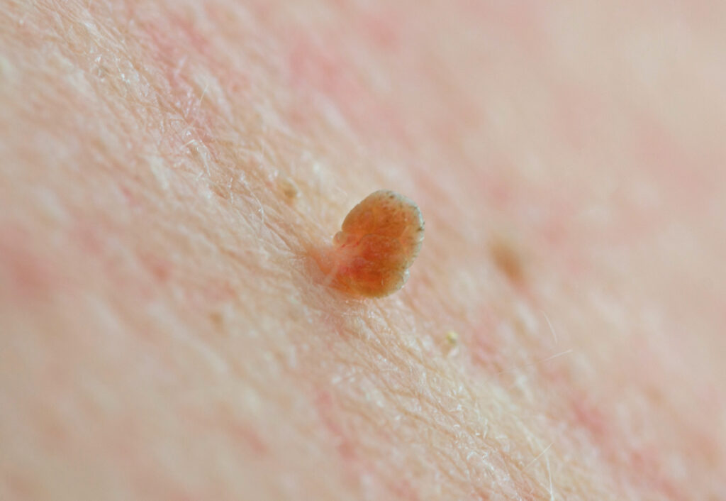 close up knot skin tag on human skin caucasian man middle age. i