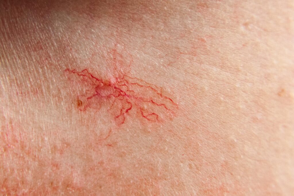araña vascular facial
