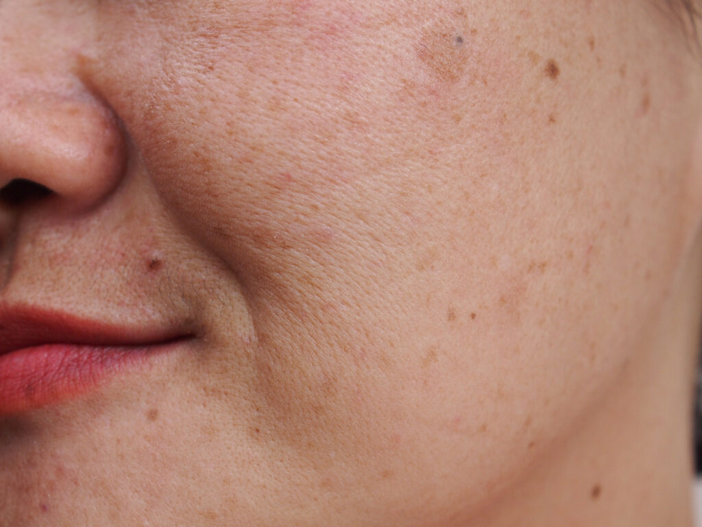 image before and after spot melasma pigmentation facial treatmen