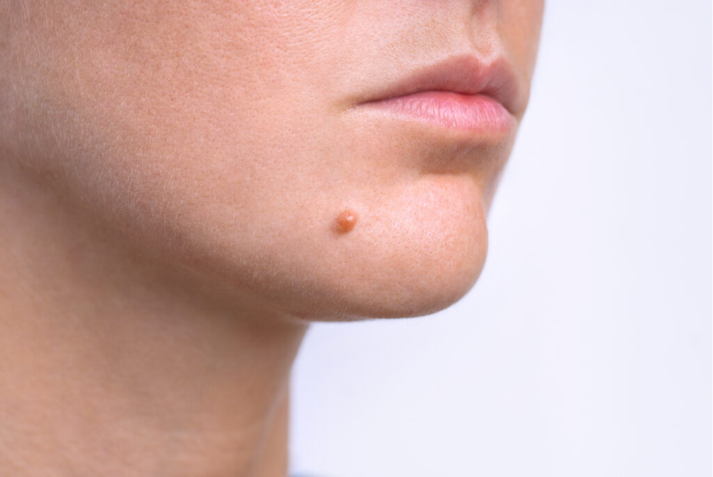 woman face before and after mole removal. laser treatment for birthmark removal from patient's face.