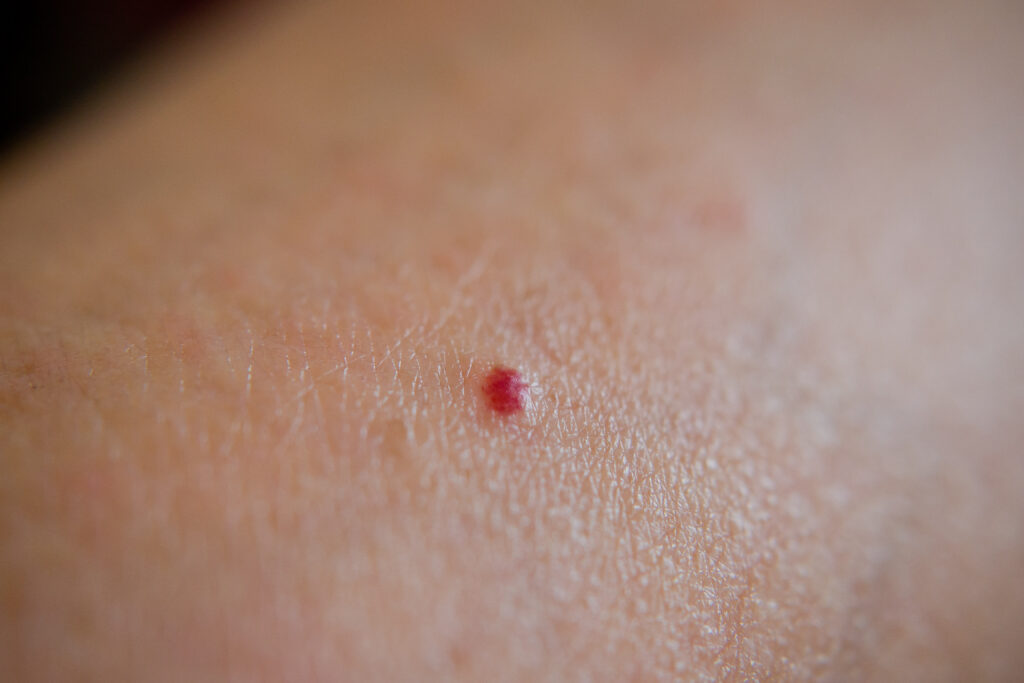 red moles on the skin