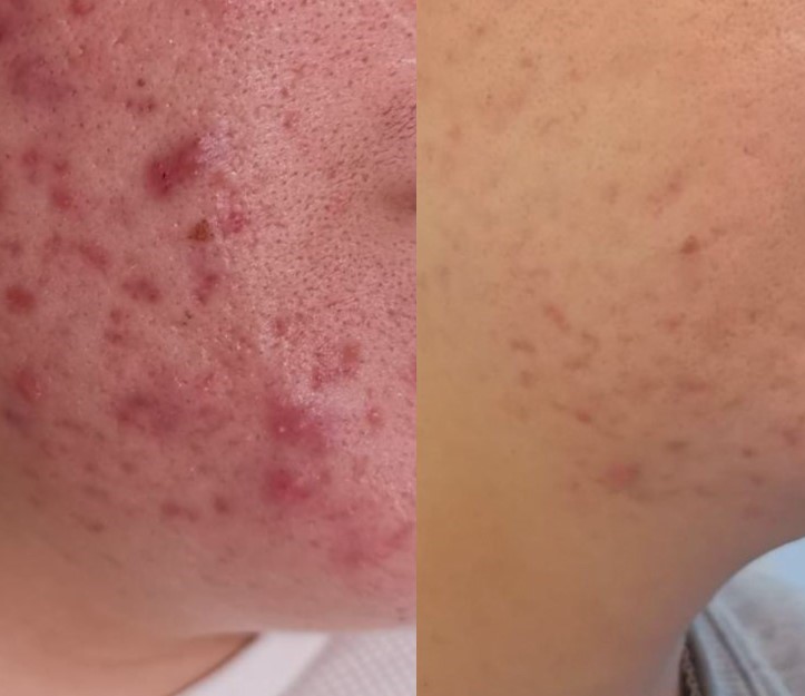 acne (1)