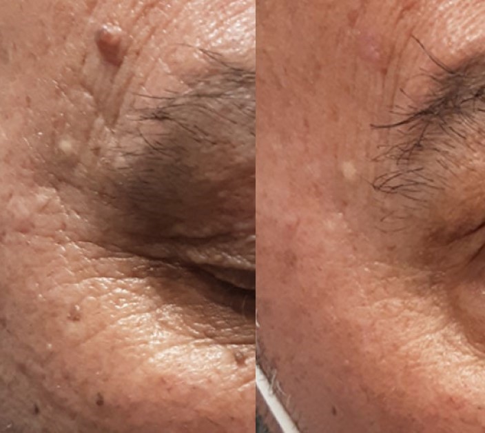 nevus