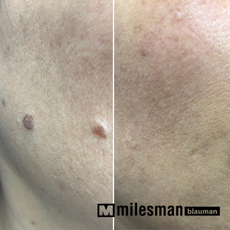voor en na keratosis